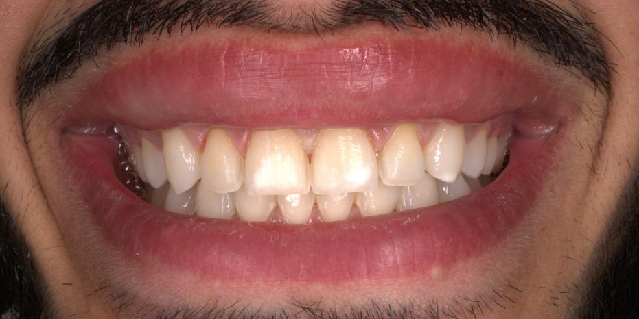 ESTÉTICA Y CARILLAS DENTALES  